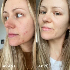 Microbiote & Peau -Cosmétiques Soldes AVANT APRES LAURA.1.4jpg