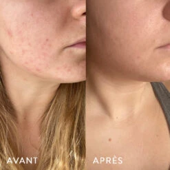 Microbiote & Peau -Cosmétiques Soldes AVANT APRES LAURA .1.3jpg